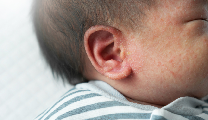 소아 아토피 피부염